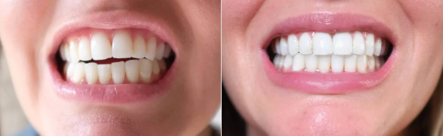 Close-up before and after of a smile straightened with Invisalign