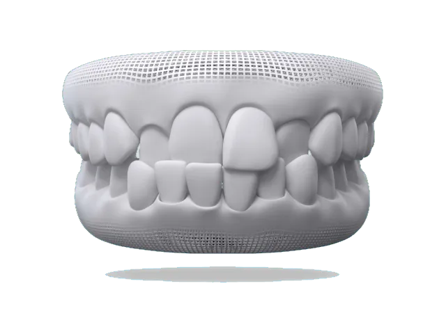 Illustration of a crossbite