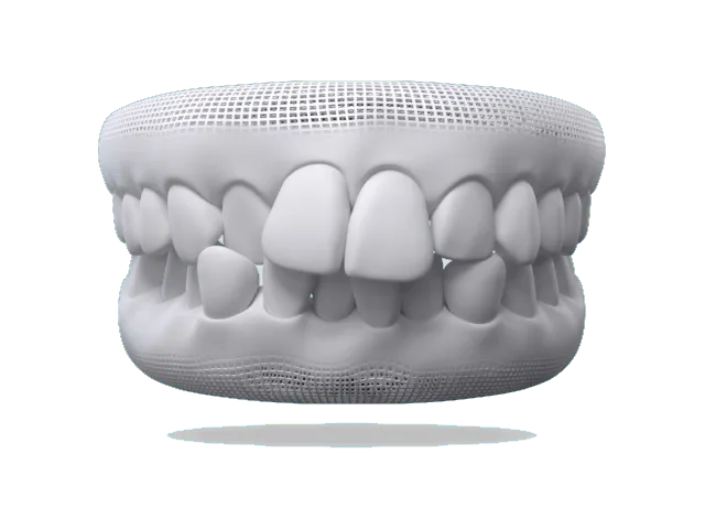 Illustration of crowded, overlapping teeth