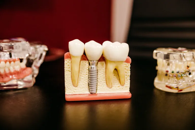 Operatory prepared for an implant procedure at Smile! San Francisco