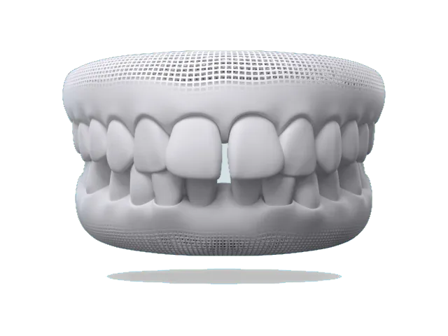 Illustration of gapped teeth with extra spacing