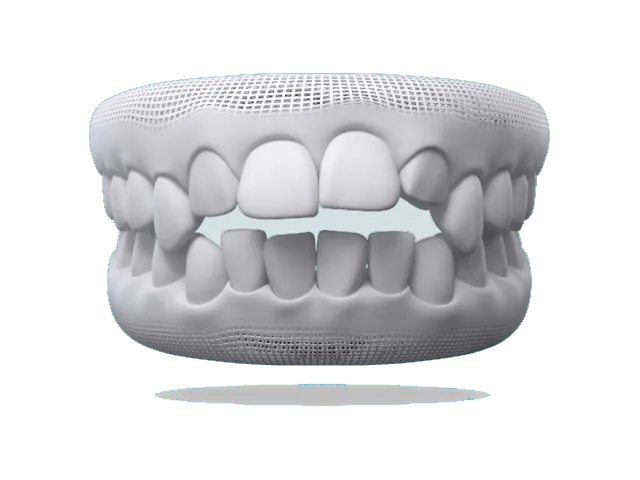 Illustration of an open bite