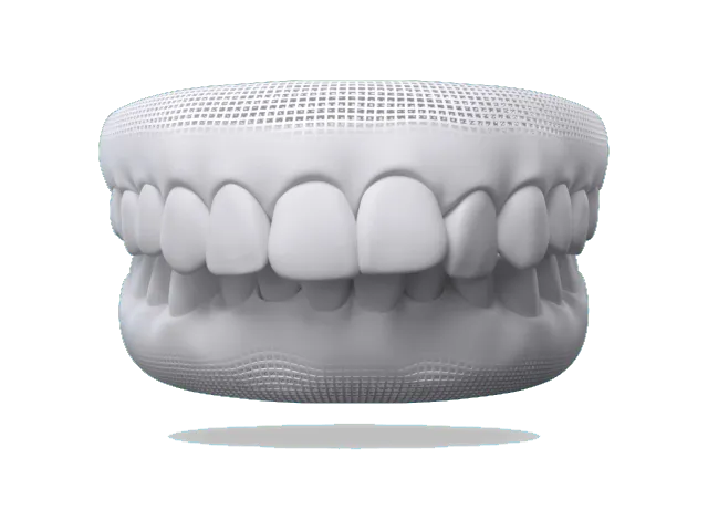 Illustration of an overbite