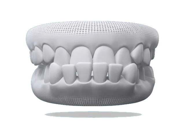 Illustration of an underbite